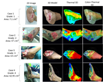 Fusion of thermal and three-dimensional data for chronic wound monitoring